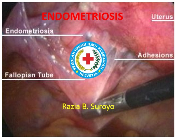gambar endometriosis